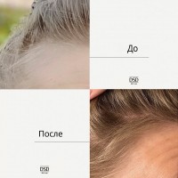 Аминопирол vs. Миноксидил: что лучше для стимуляции роста волос?